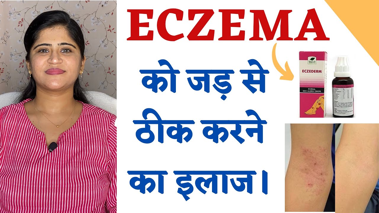 Eczema Treatment ॥ Skin Allergy और Eczema को जड़ से ठीक करने का इलाज ॥