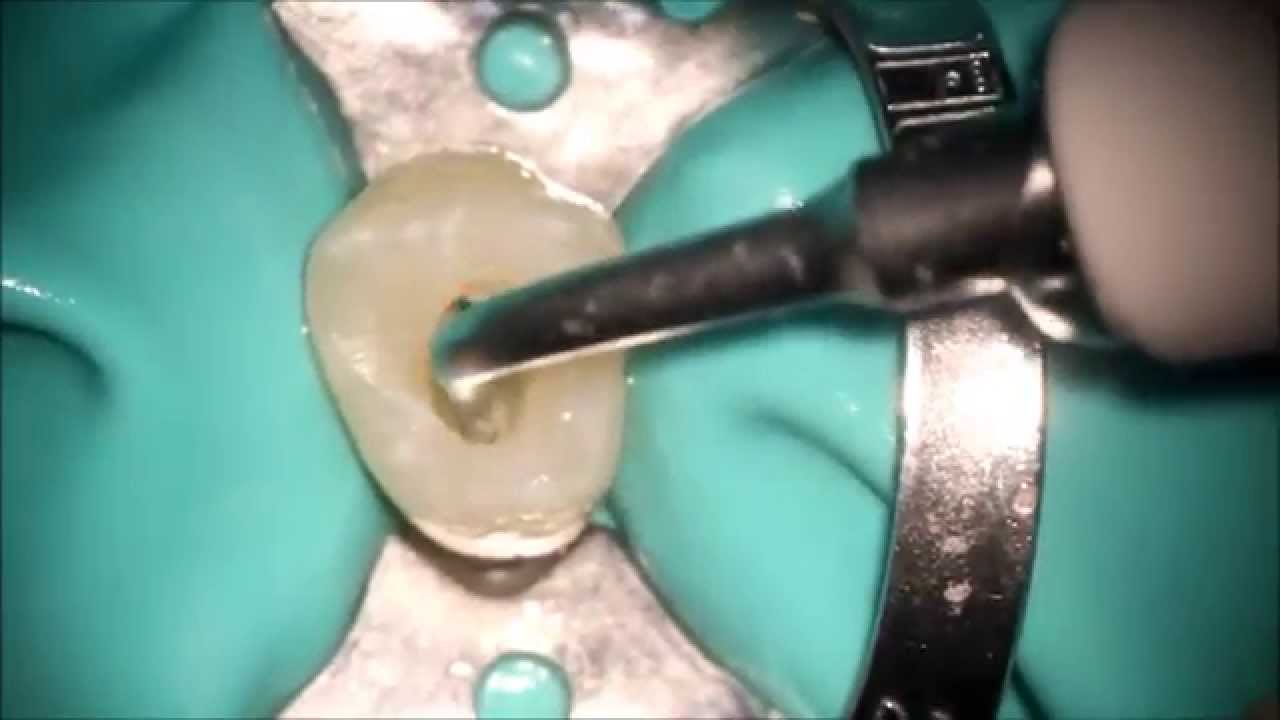 second maxillary premolar