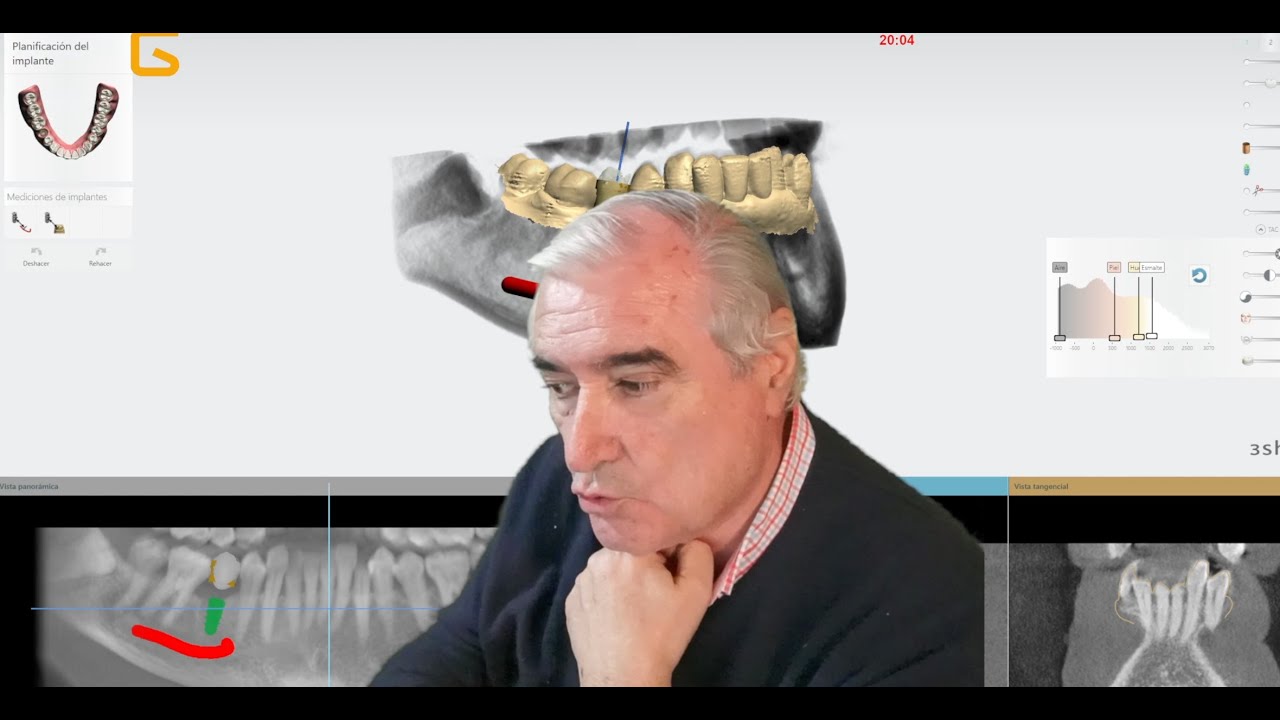 RealGuide® al Detalle: Adquisición de Archivos y Alineamiento de Superficies 3D.     (1ª parte)