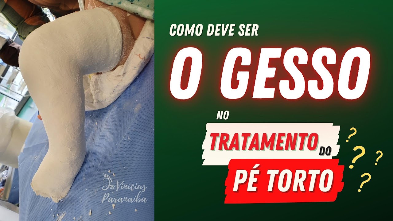 O GESSO NO TRATAMENTO PÉ TORTO CONGÊNITO