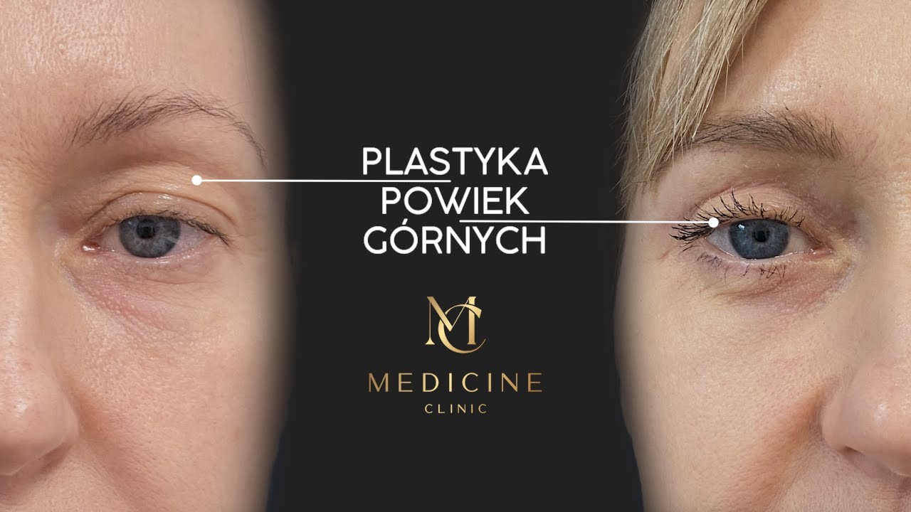 Plastyka powiek górnych. Wszystko co musisz wiedzieć. Lek. Edyta Czapczyńska