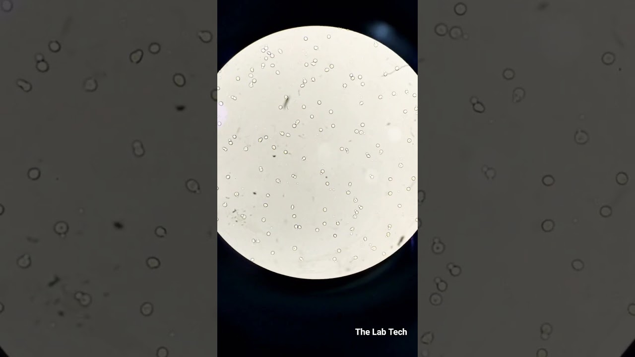 Budding Yeast in Urine🔬 