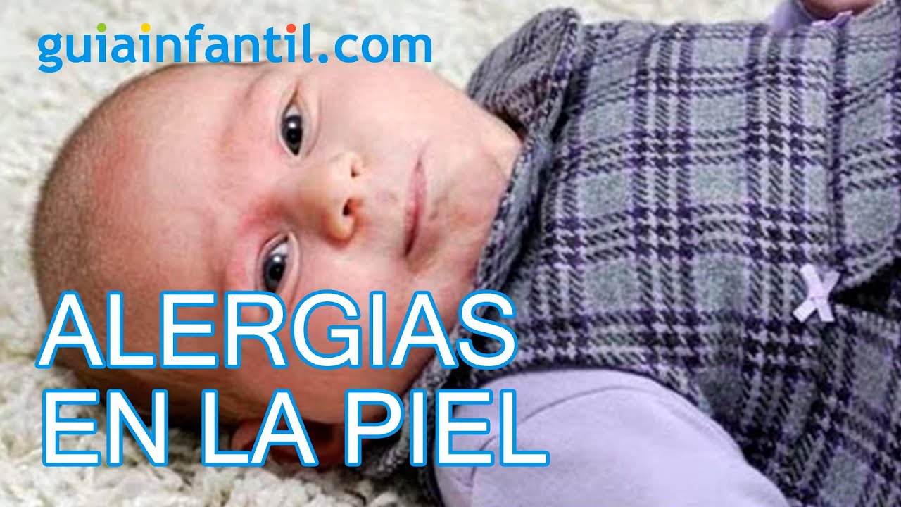 Alergias en la piel de los niños