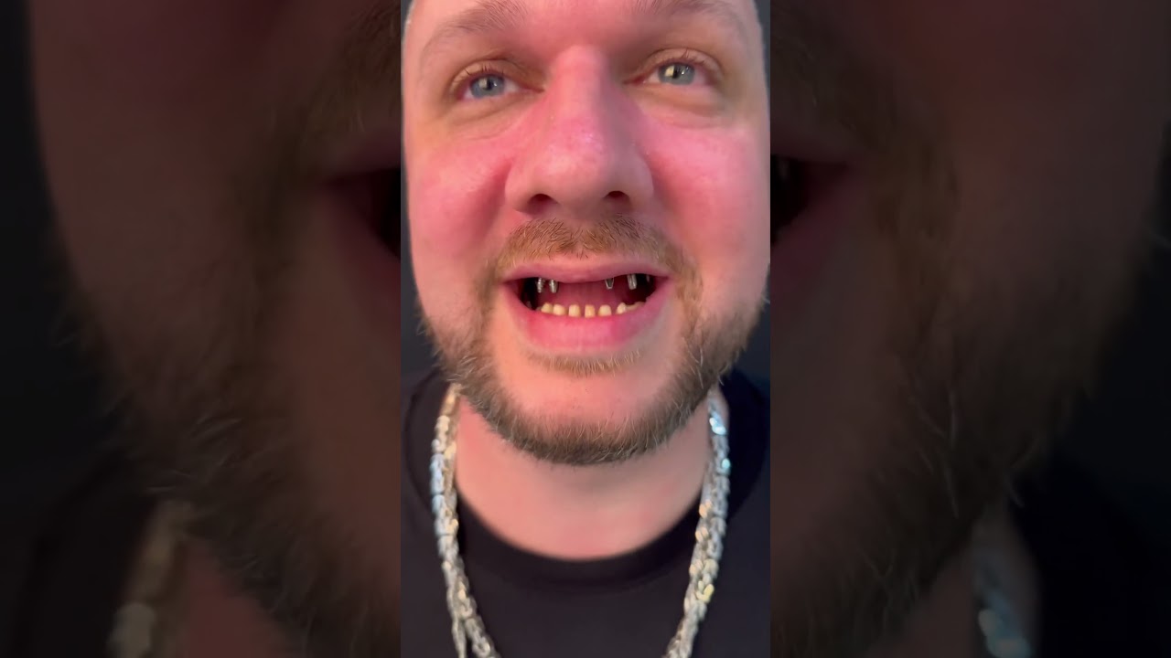 Ein neues L&auml;cheln f&uuml;r Steven: Perfektion durch Zahnimplantate - www.medicaldrguide.com