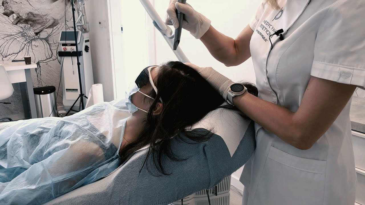 Laserowa stymulacja wzrostu włos&oacute;w - laser FOTONA