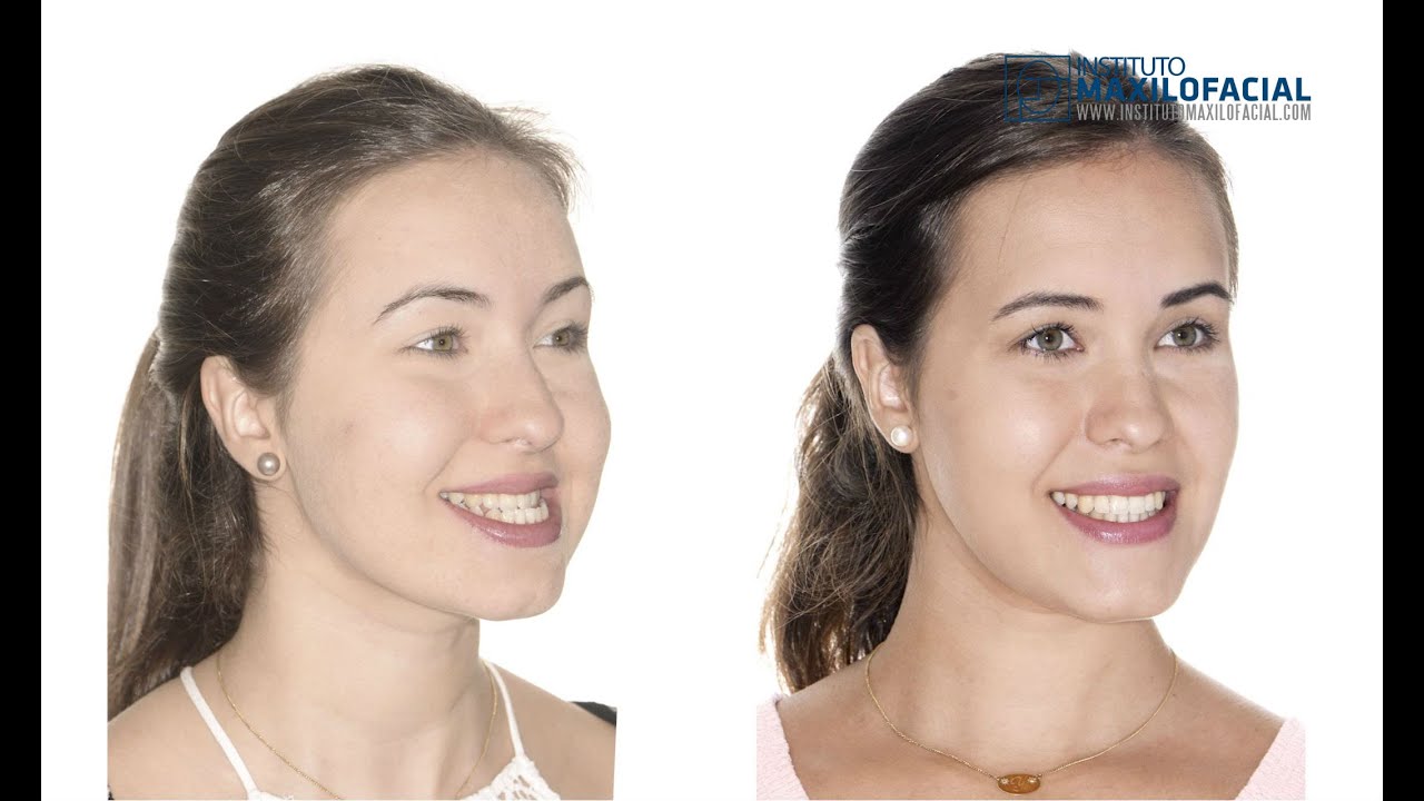 Cirugía ortognática bimaxilar. Mentoplastia. Caso #32: Ylenia - Clase 3