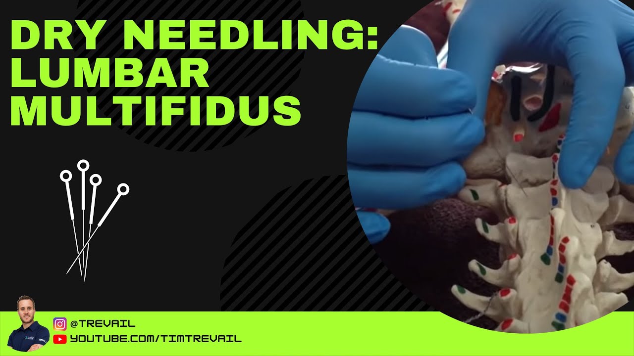 Dry Needling: Multifidus