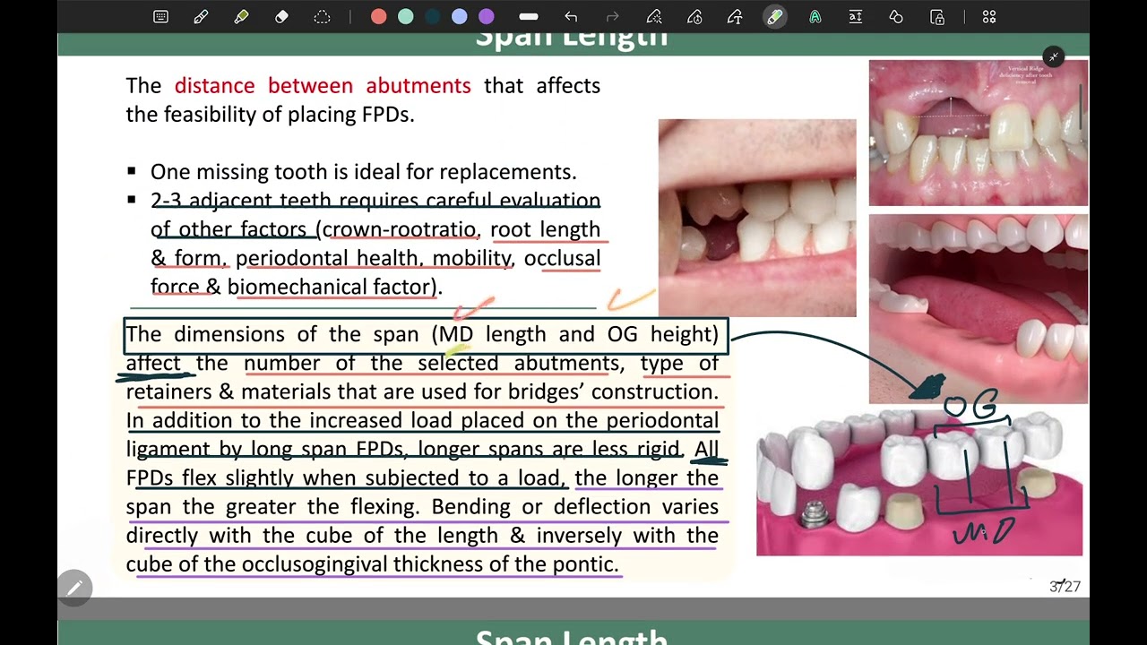 Biomechanical Considerations |crown|fifth stage 