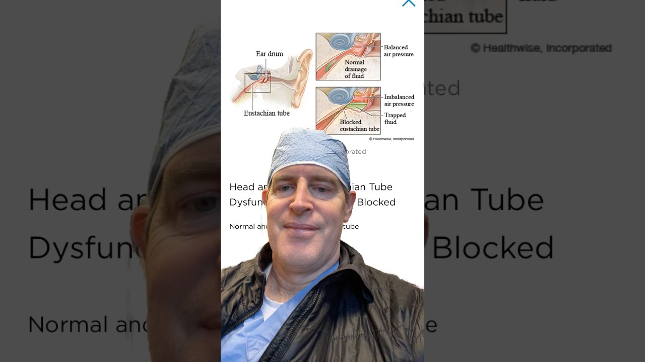Ear fluid explained from a pediatric ENT #eustachian . #eustachiantube #ear #earinfection #mom #dad