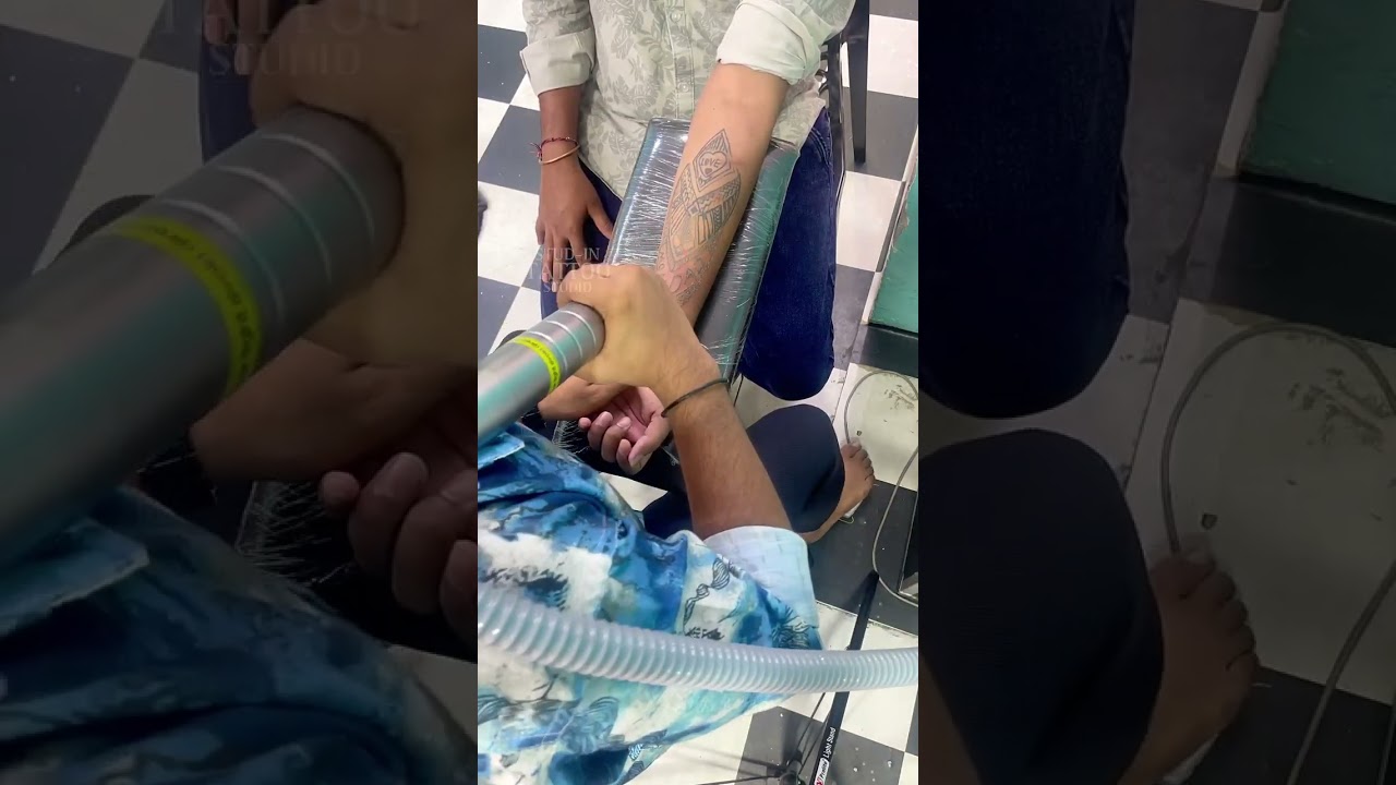 painless tattoo removal 
