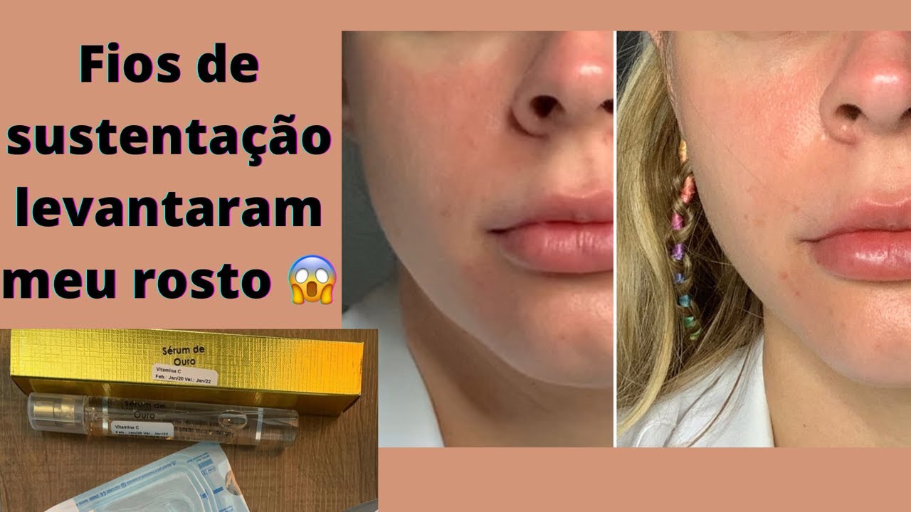 Fios de sustentação de colágeno e ouro Não Invasivos