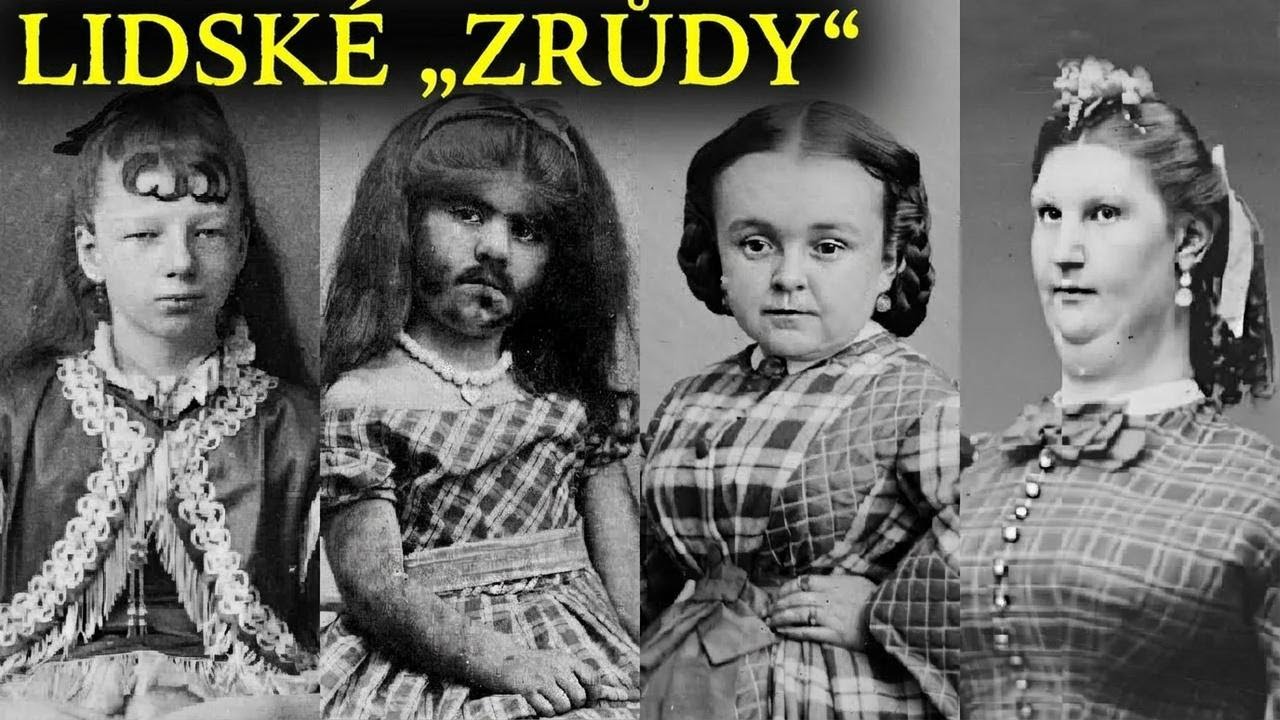 Neuvěřitelné příběhy lidí, kteří byli považováni za lidské zrůdy