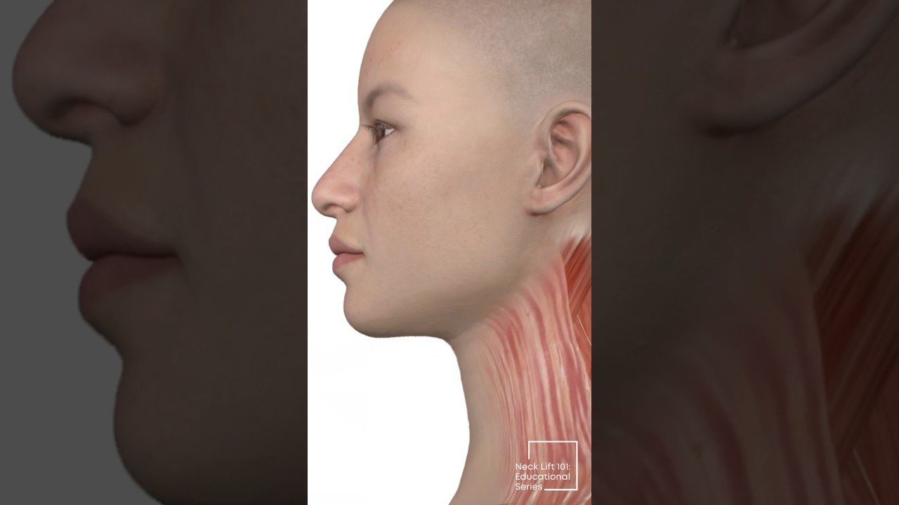 Neck Lift 101: Mastoid Crevasse Technique for a Sculpted Neckline Lift | Part 7 #NecklineLift