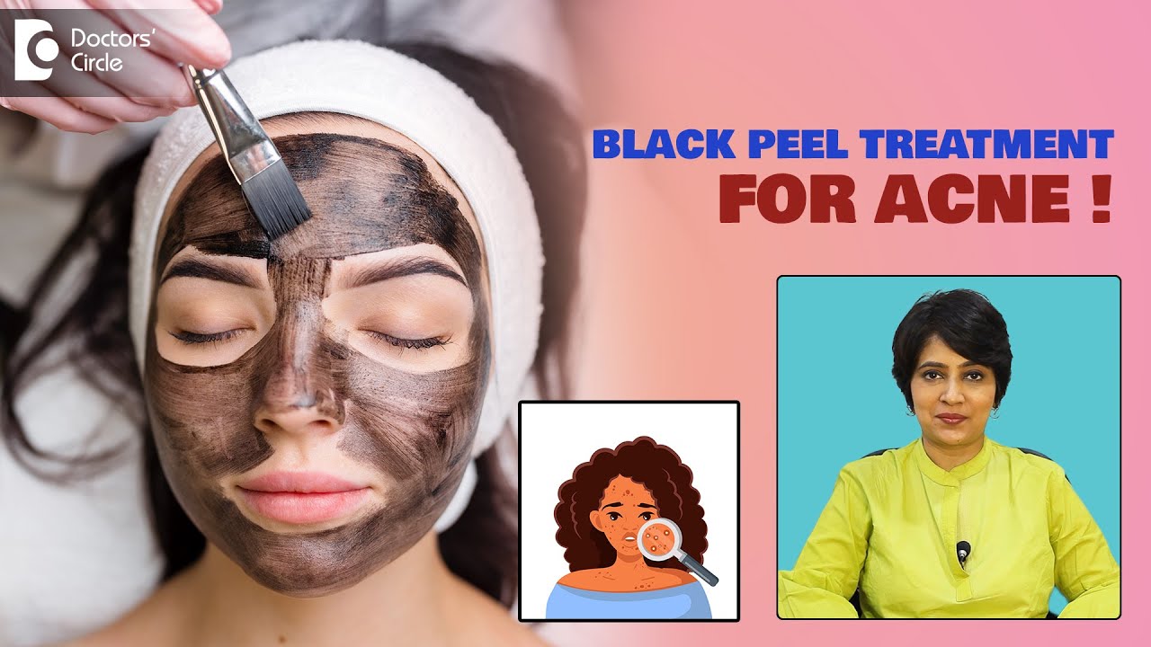 Black Peel Acne Treatment| Chemical Peel for Acne| Severe Acne   - Dr.Rasya Dixit | Doctors' Circle