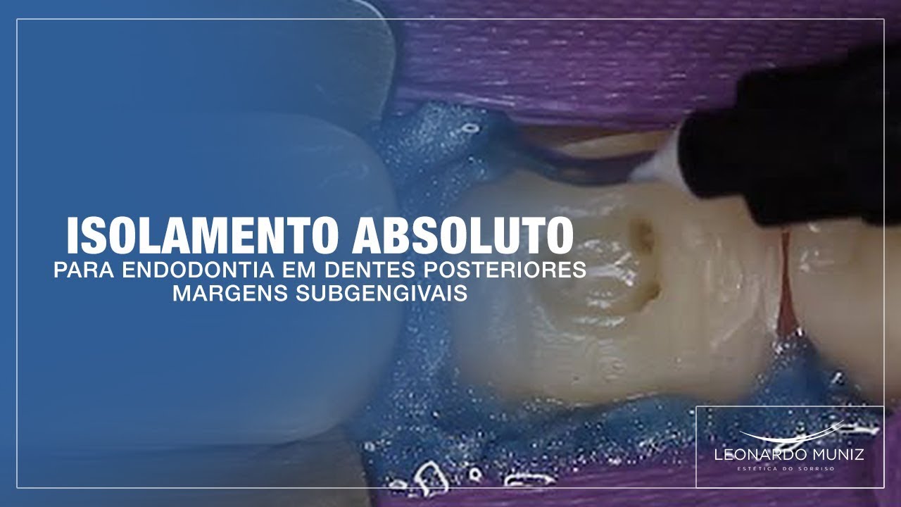 Isolamento Absoluto para Endodontia em Dentes Posteriores.  Margens Subgengivais