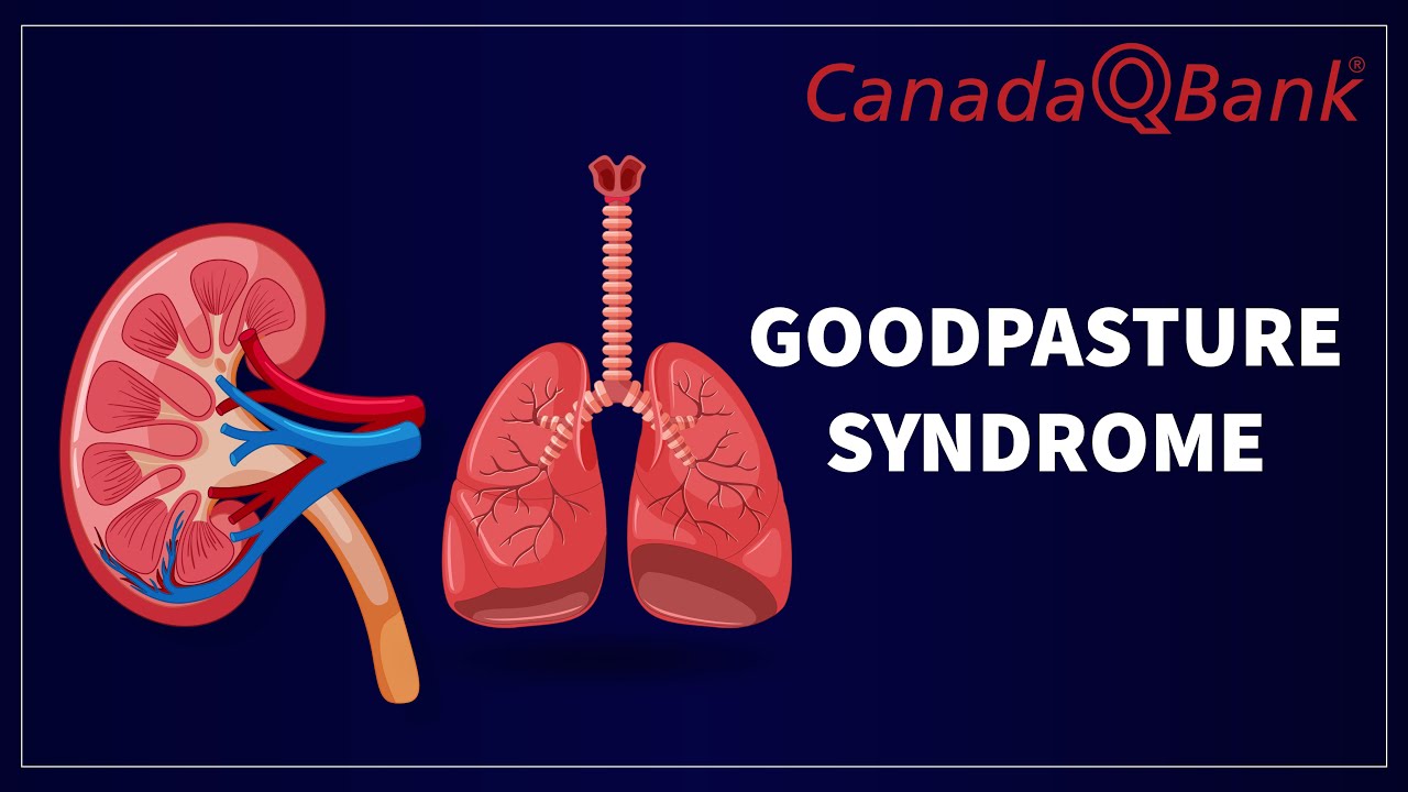Goodpasture Syndrome: Causes, Symptoms, Diagnosis & Treatment | Rapid Review | CanadaQBank