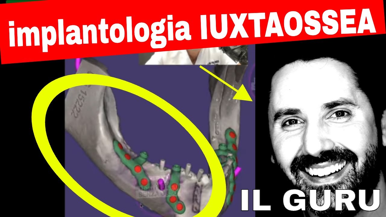 Implantologia Iuxtaossea: Il Guru