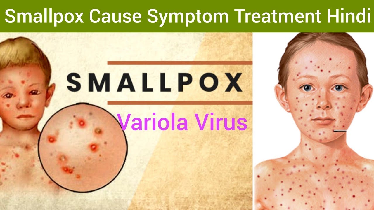 Smallpox (Variola) Cause Symptoms Diagnosis Treatment in Hindi | Smallpox Hindi | What is Smallpox