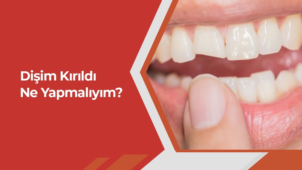 Dişim Kırıldı Ne Yapmalıyım?
