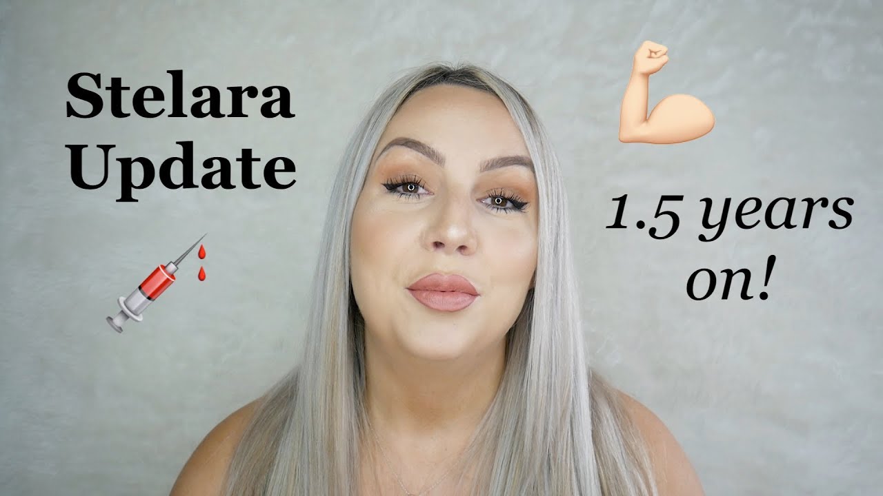 Stelara (Ustekinumab) Update-  1.5 YEARS ON! Kristy J