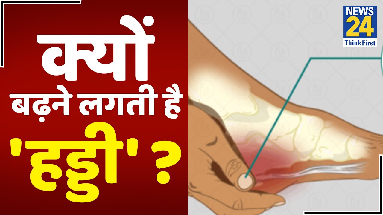 Sanjeevani : डॉक्टर प्रताप चौहान से जानिए हड्डी बढ़ने का क्या है कारण ?