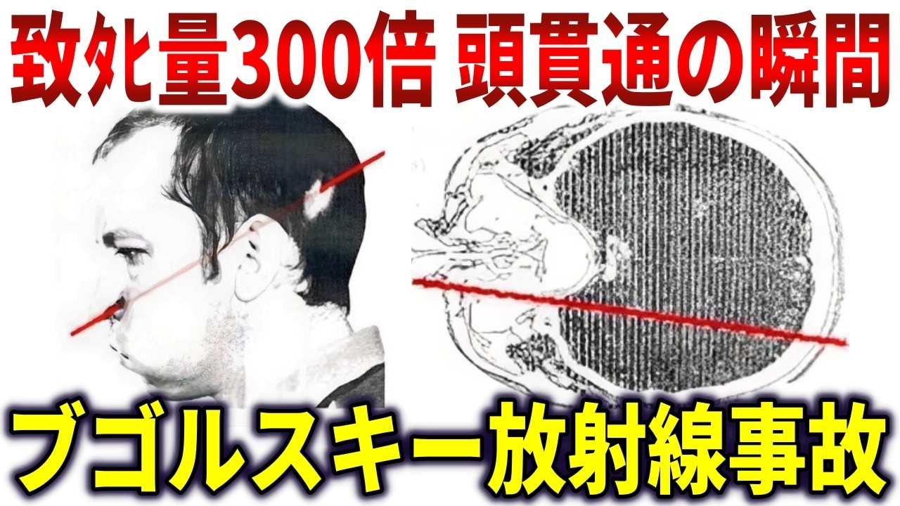 ブゴルスキー放射線事故。2000グレイ陽子ビームが頭部貫通した研究者の最後【ゆっくり解説】