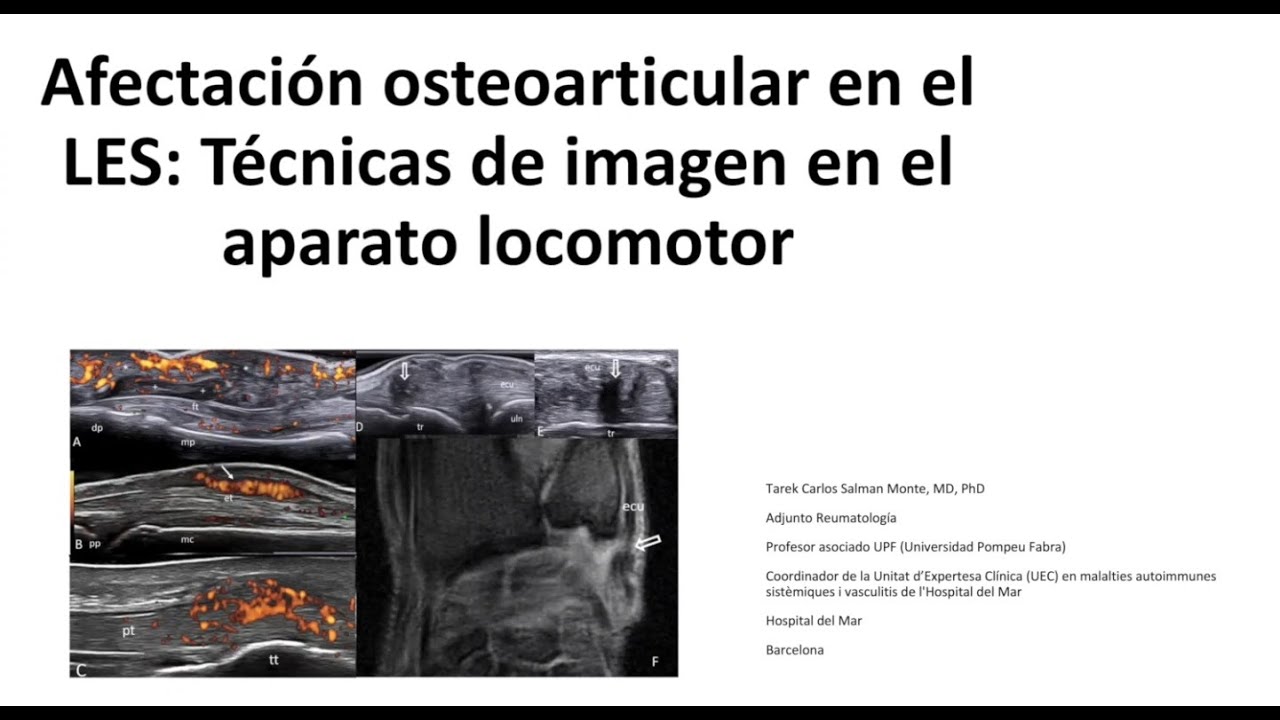 Ponencia Afectación osteoarticular en el LES por el Dr. Tarek Carlos