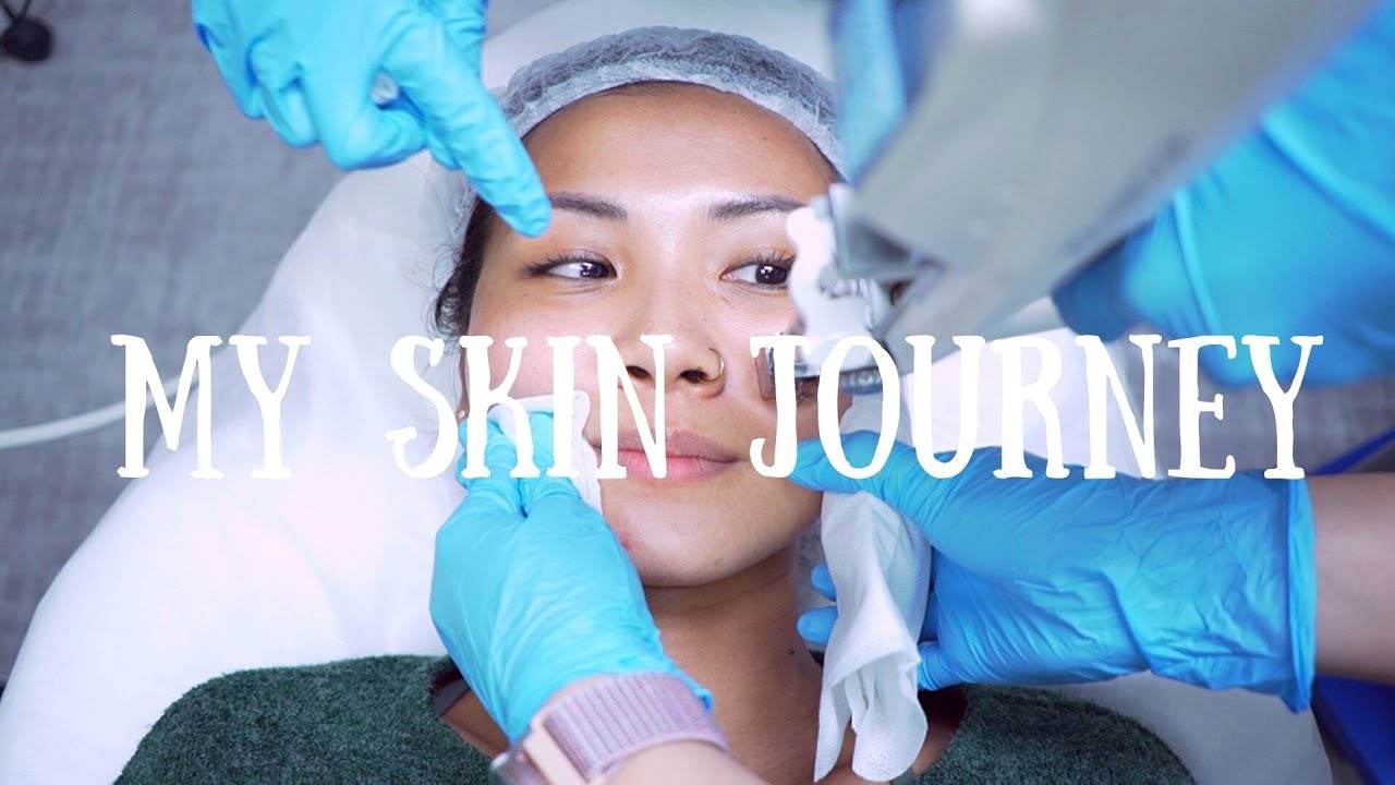I tried Rejuran to reduce my acne scarring