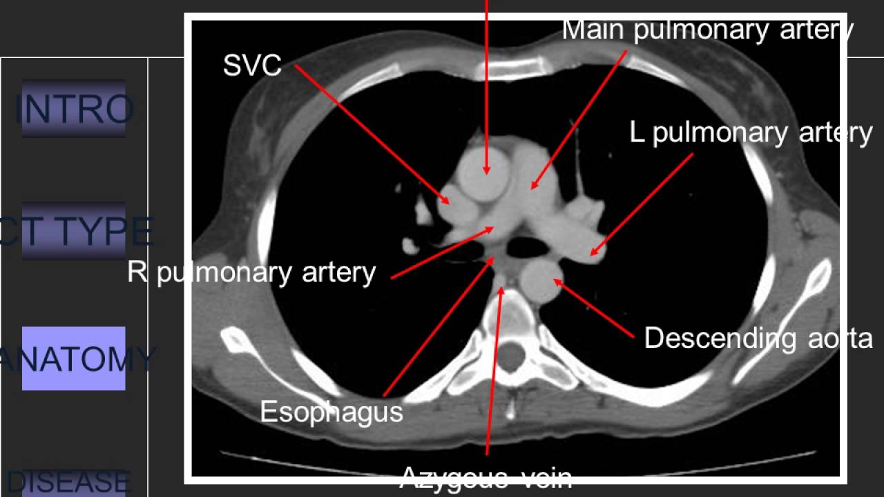 Approach to CT Chest  849