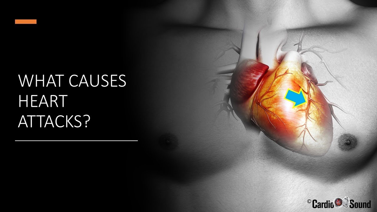 After a Heart Attack- What causes heart attacks? Blockage?