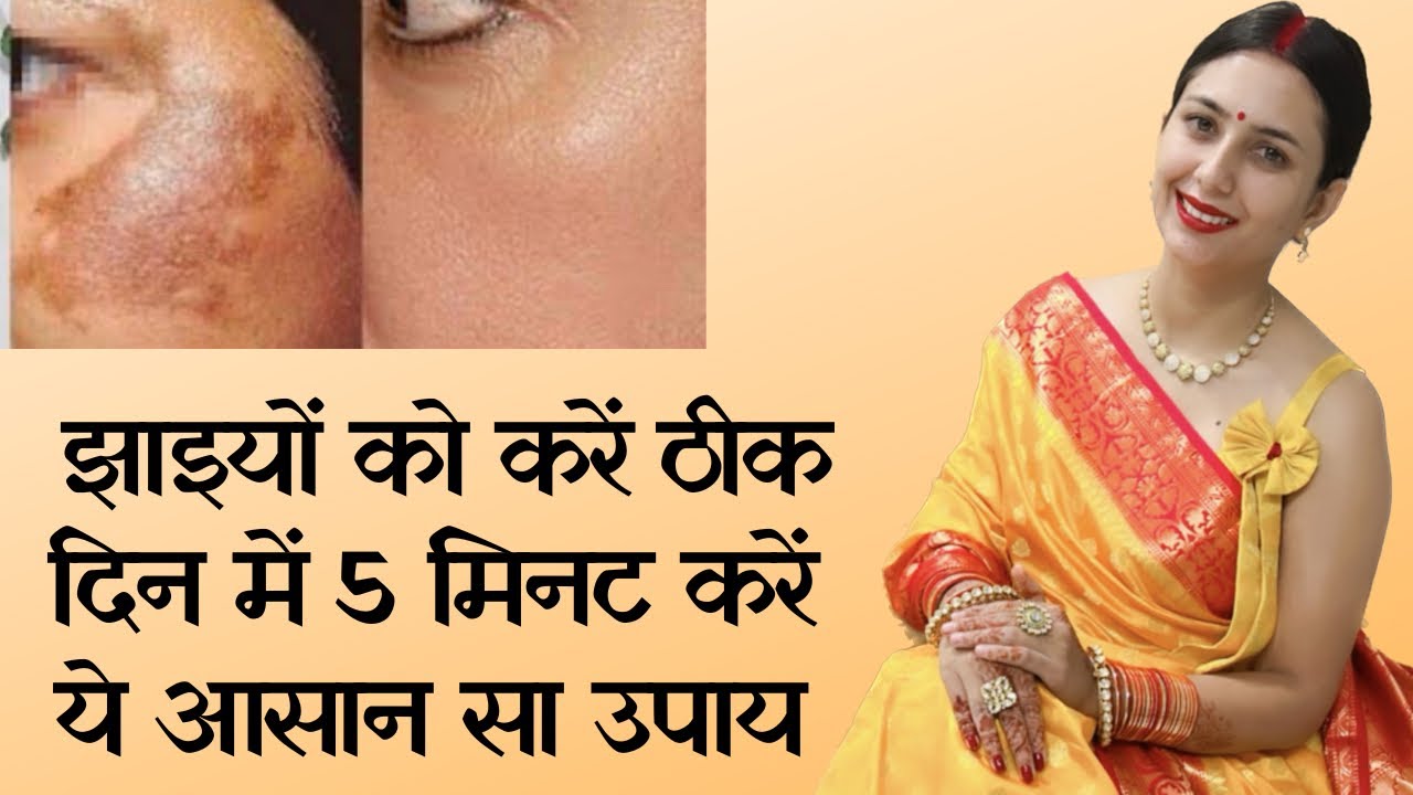 Jhaiyo ko hamesha ke liye theek kare | Hyperpigmentation Melasma Home Remedy | Dr. Upasana Vohra