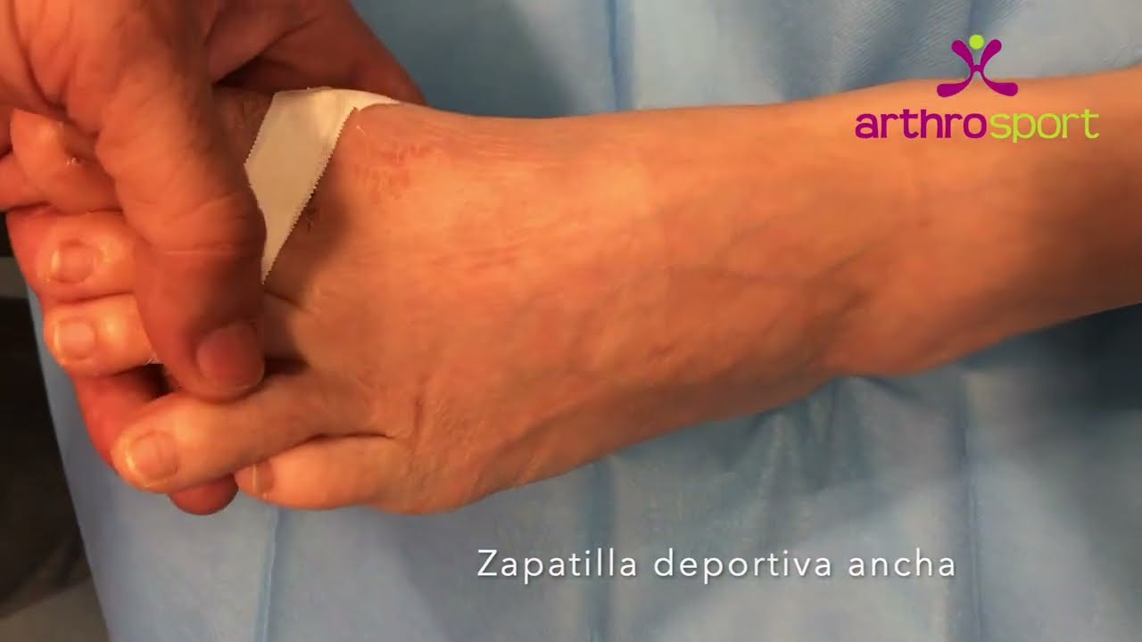 SEGUNDA CURA AL MES DE LA INTERVENCION TRAS CIRUGIA PERCUTANEA DEL JUANETE