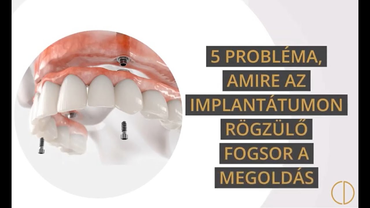 Implantátumon rögzülő fogsor: 5 TOP probléma, amit megold a fogbeültetés