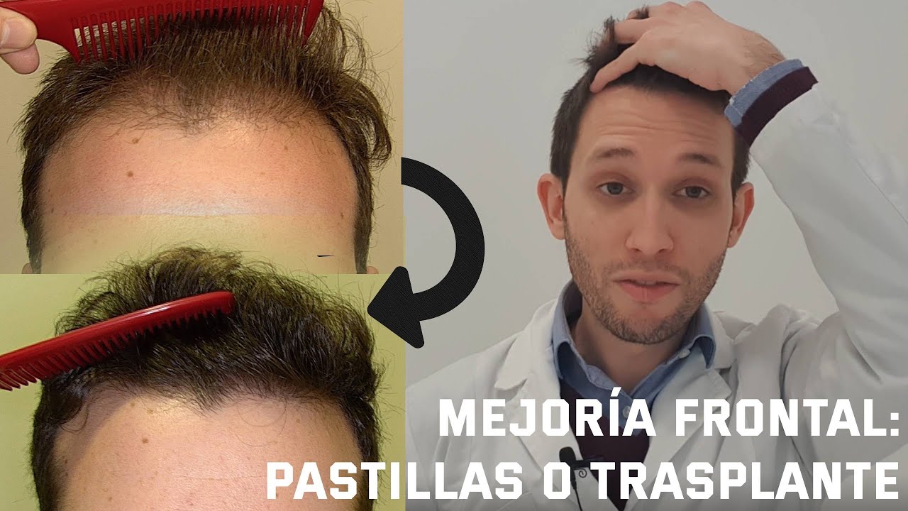 DERMATÓLOGO explica cómo mejorar la ALOPECIA ANDROGÉNICA FRONTAL