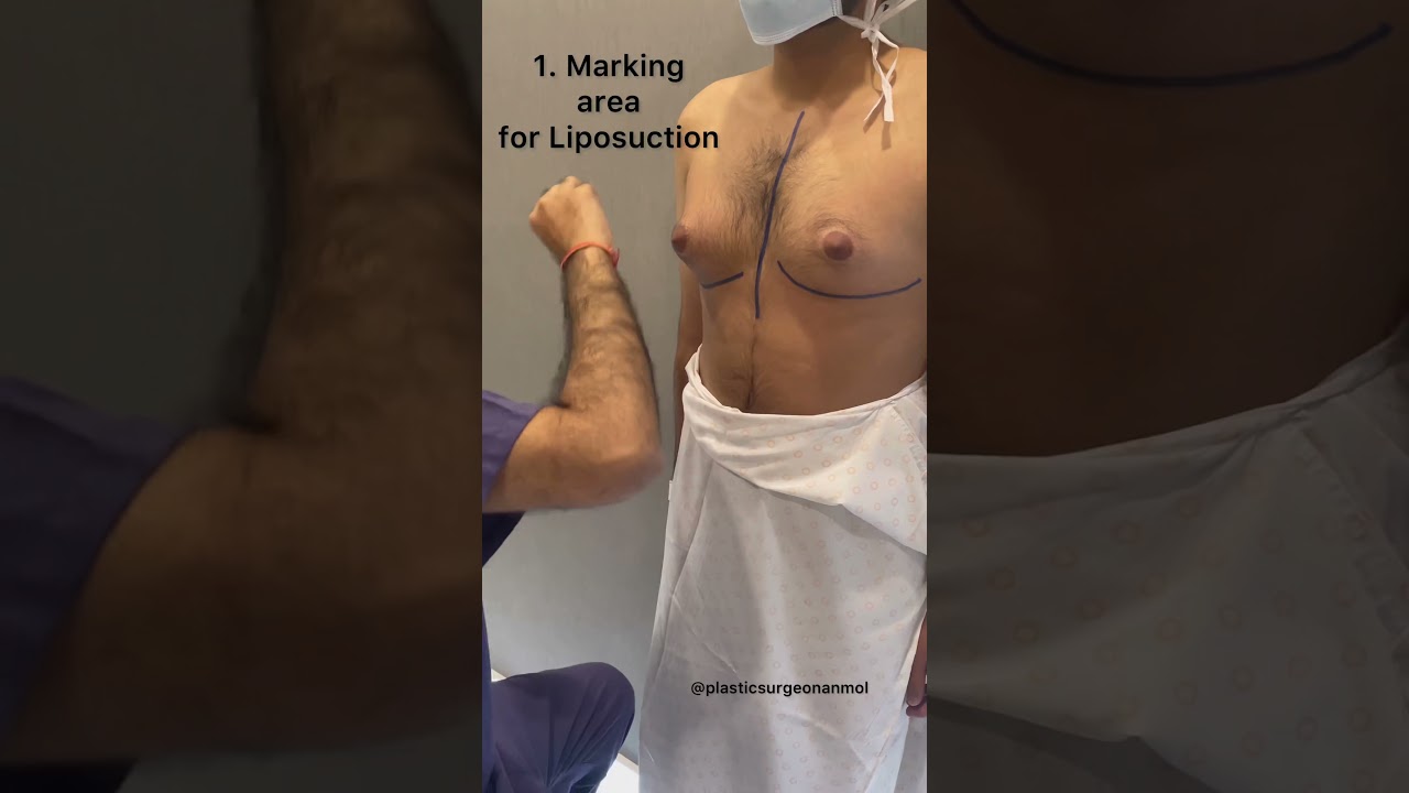 Markings in Gynecomastia | Dr. Anmol Chugh-Gynecomastia Surgeon in India | Plastic Surgeon in Delhi