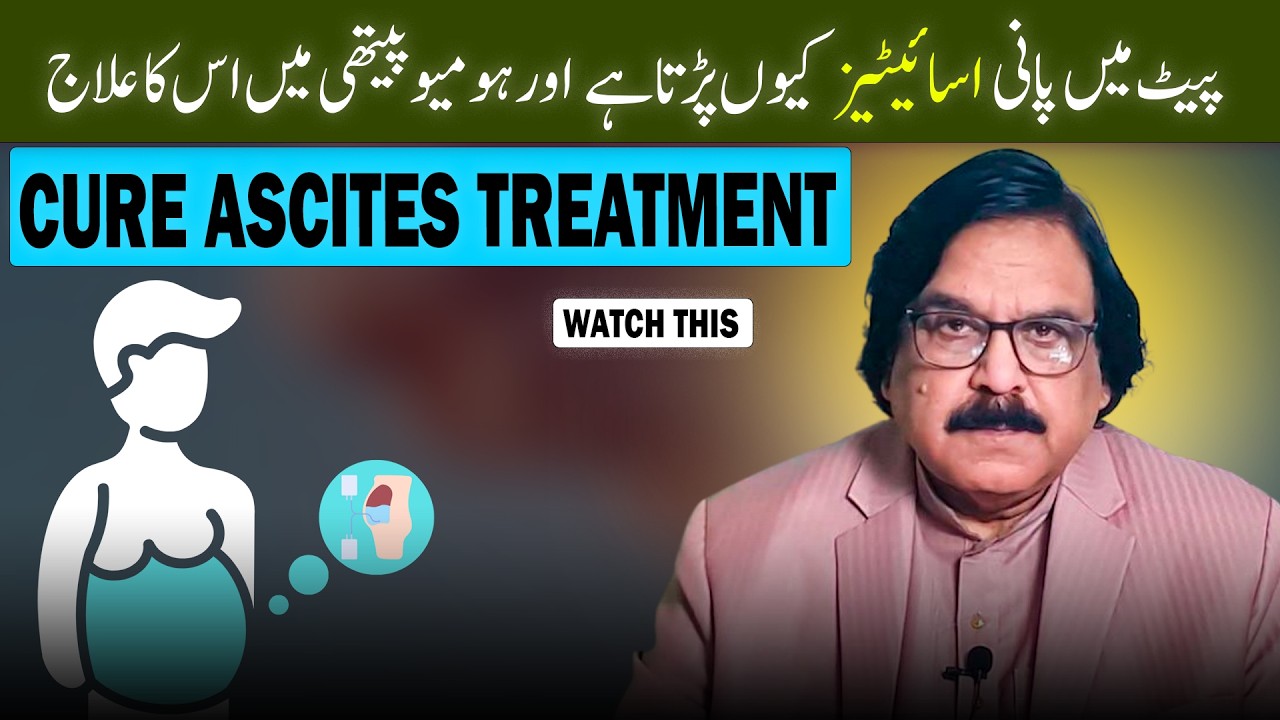 Ascites Treatment | Homeopathic treatment | explain by Dr Ishrat Naeem Bhatti