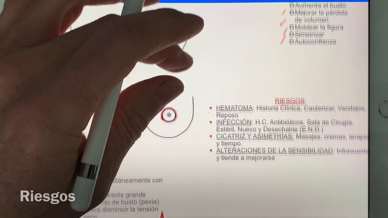 PLASTIA PERIAREOLAR, CORRECCION DE AREOLA, PEXIA PERIAREOLAR VIDEO CONSULTA DR.JORGE ANDRES AFANADOR
