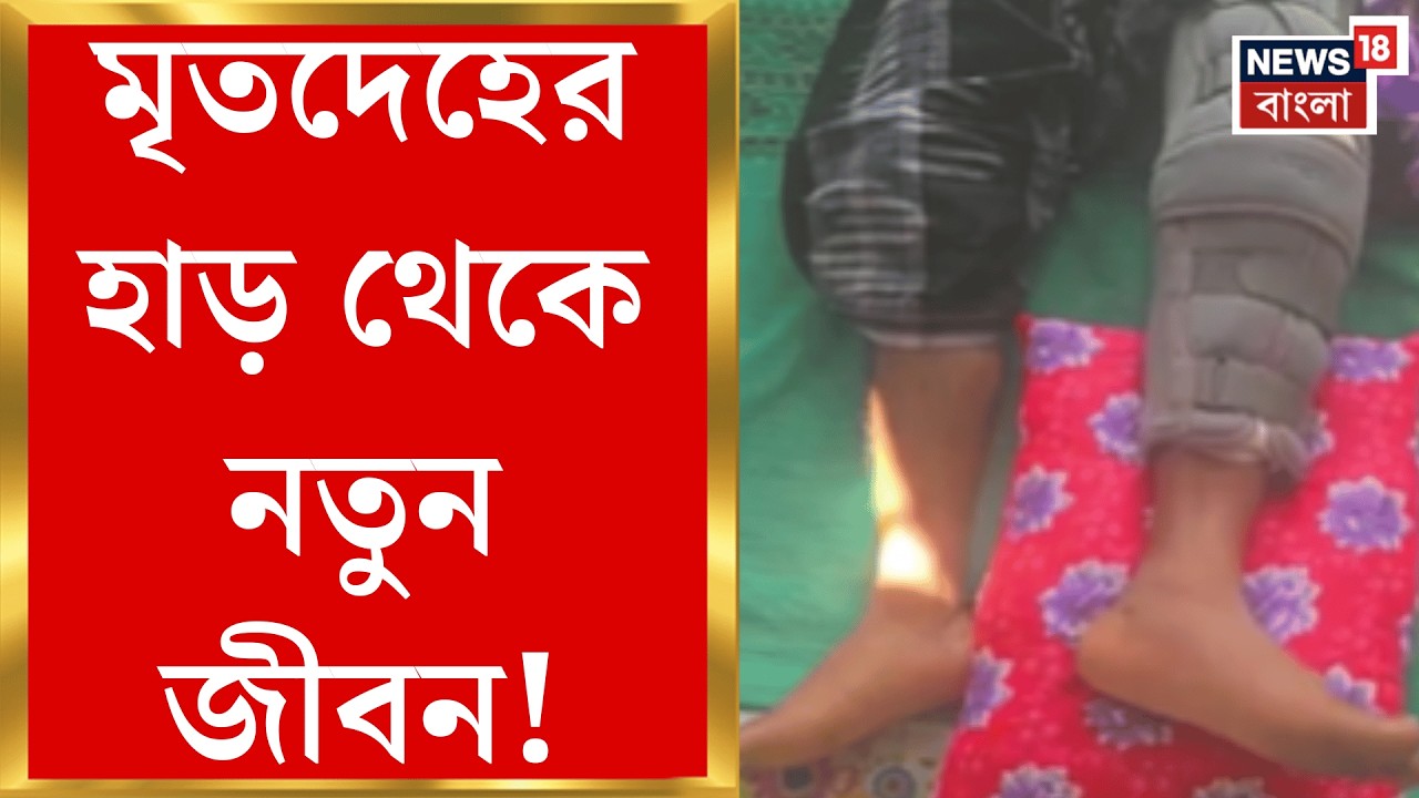 RG Kar News | পূর্ব ভারতে প্রথম! আরজি করে মৃত মানুষের হাড় প্রতিস্থাপন যুবকের শরীরে | Bangla News