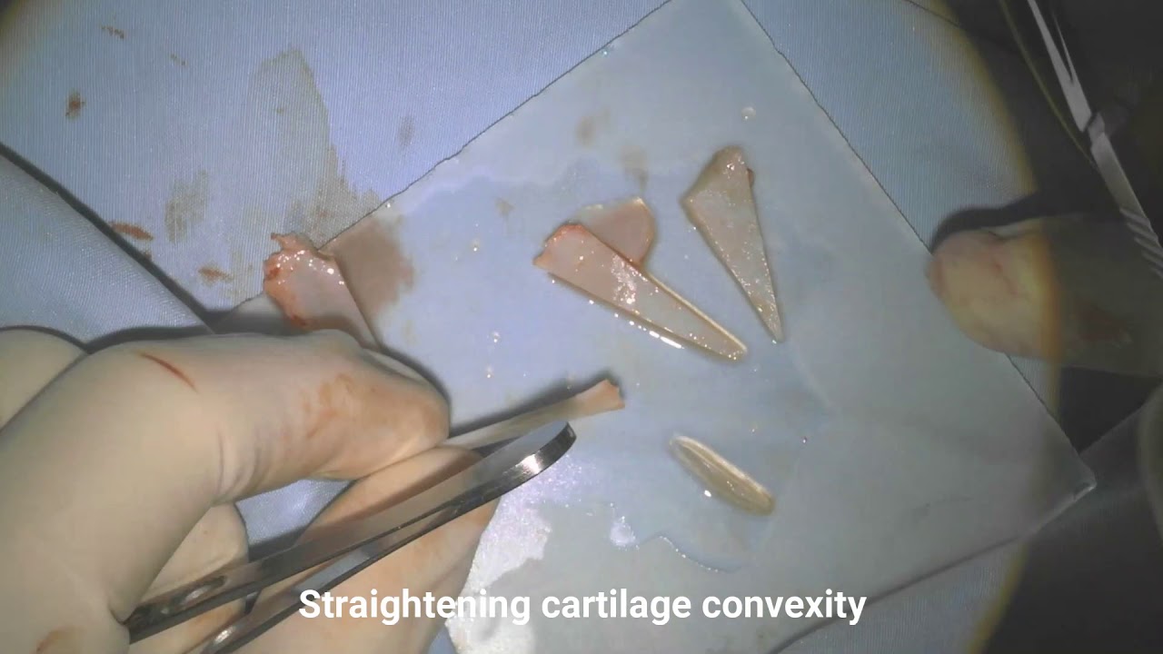 Hernan Chinski - septal extension graft