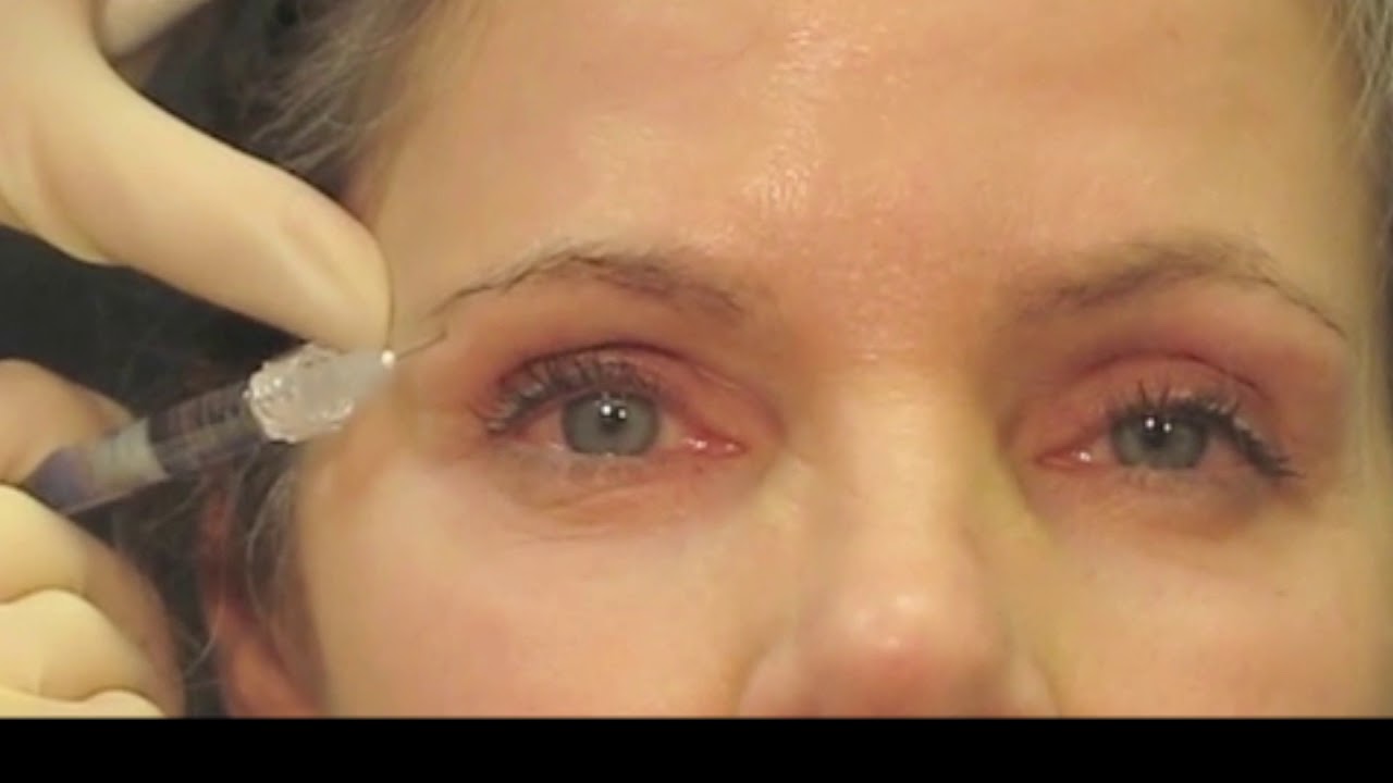 Filler Technique for Rejuvenation of the Upper Periocular Area