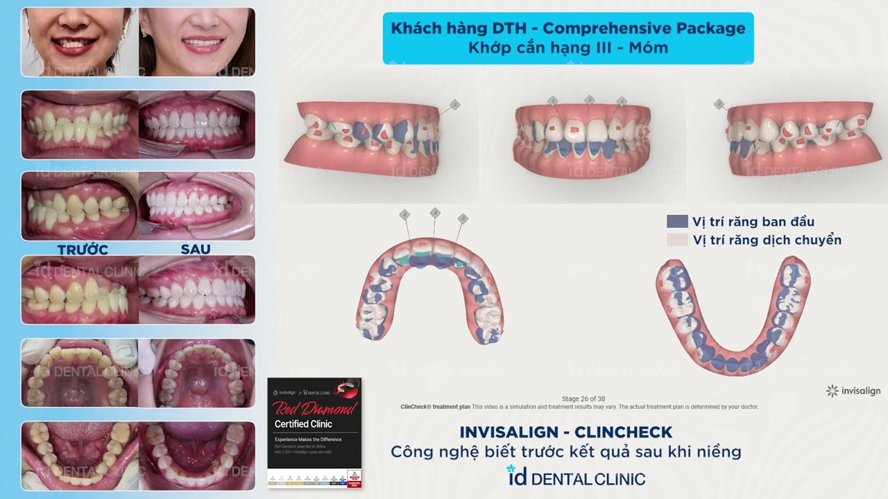 Hàm Móm | Invisalign ClinCheck id Dental Clinic