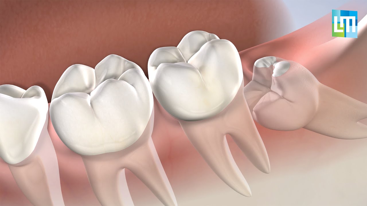 Post-Op Instructions: Wisdom Teeth | Lehman & Menis Dental Implant and Oral Surgery Specialists