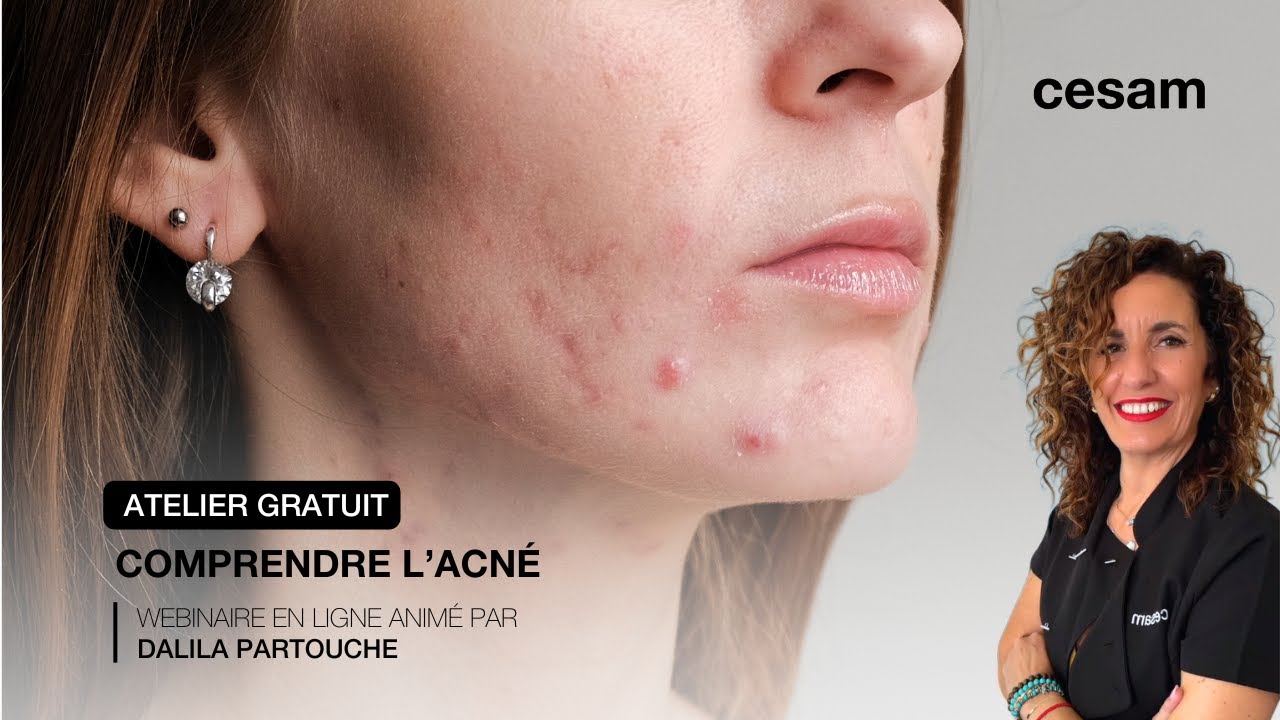 Atelier - Comprendre l'acné
