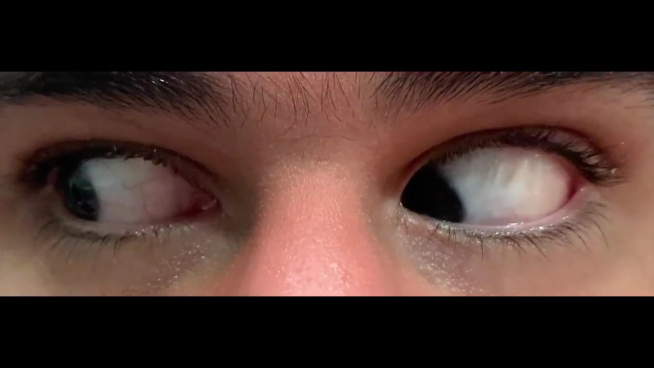 Supranuclear upgaze palsy