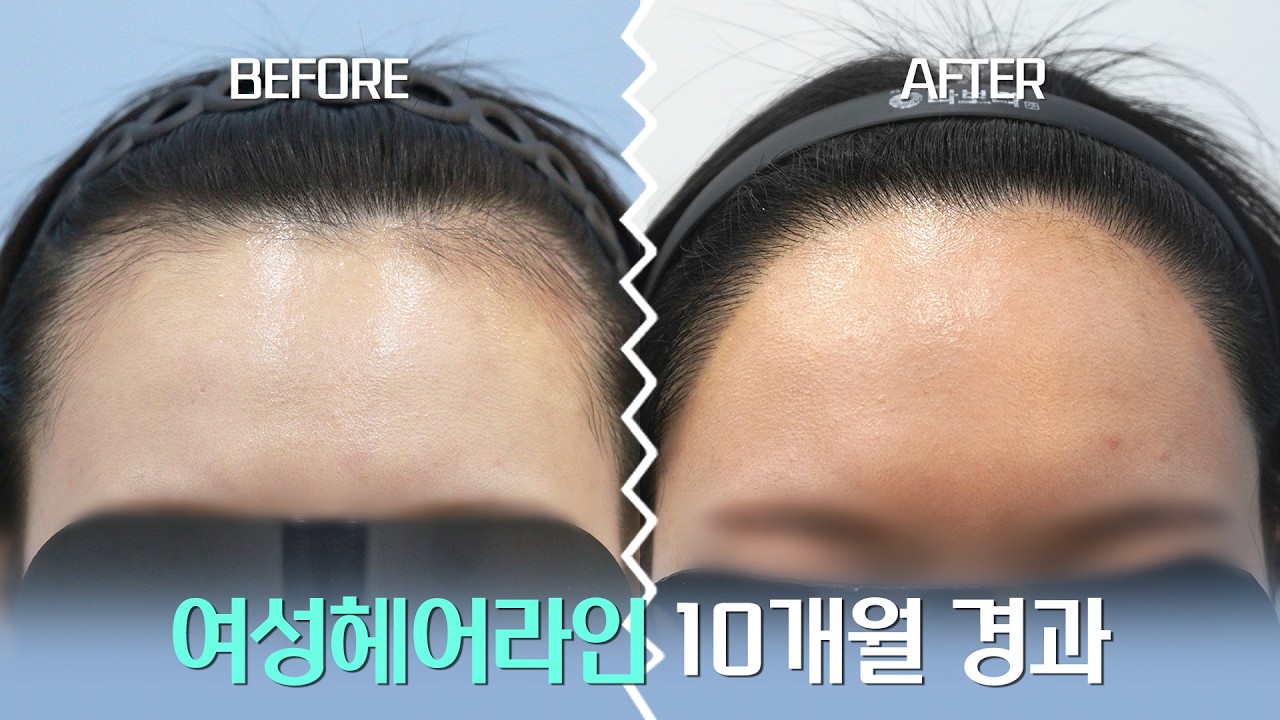 여성헤어라인 10개월 경과 3700모 I 압구정모비앙의원_경과모음