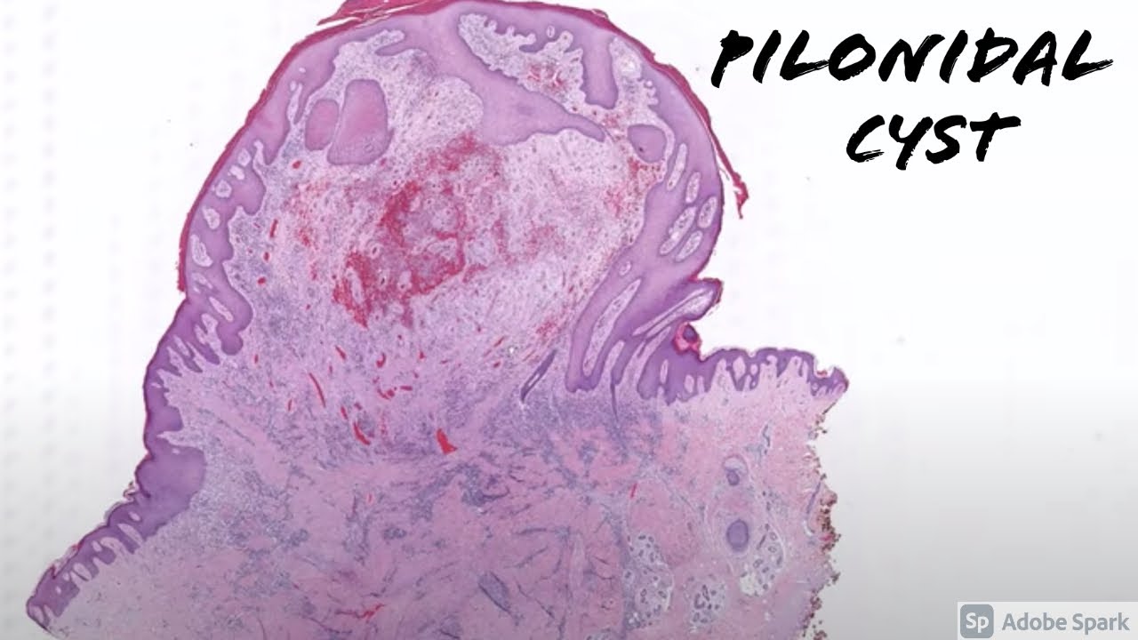 Pilonidal cyst/sinus/tract: 5-Minute Pathology Pearls