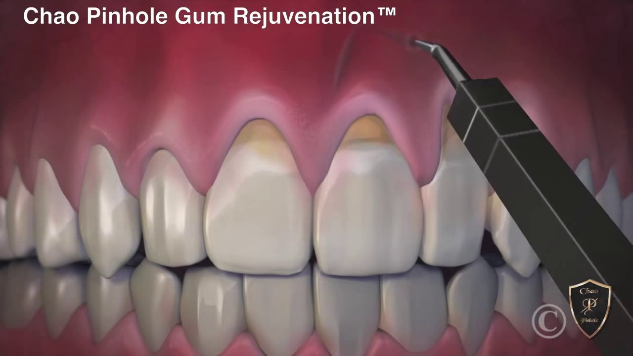 Chao Pinhole Gum Rejuvenation