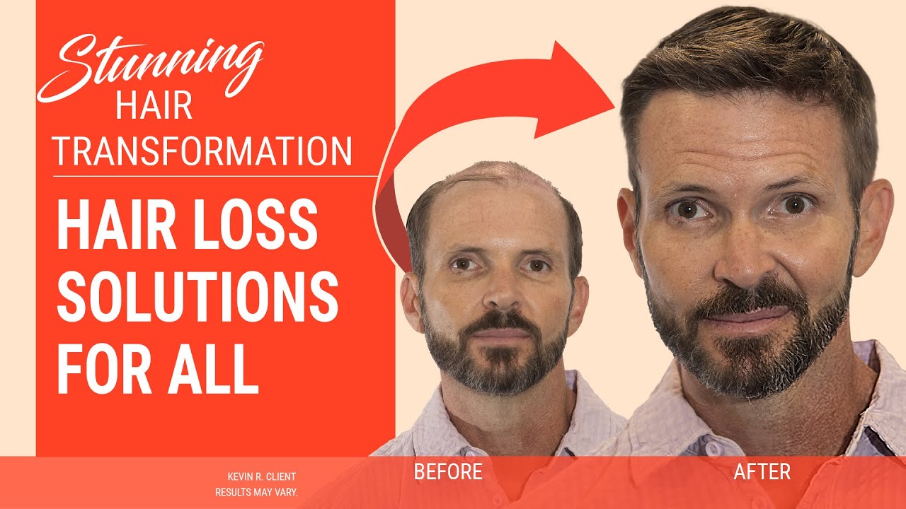 All the Benefits, None of the Worry – HairClub has a Solution for Everyone!