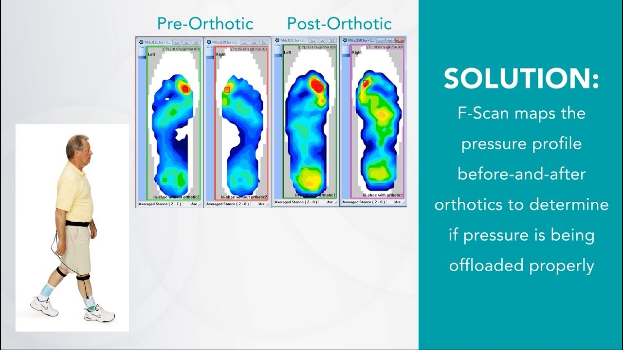 F-Scan: In-Shoe Technology to Assess Pressure Redistribution