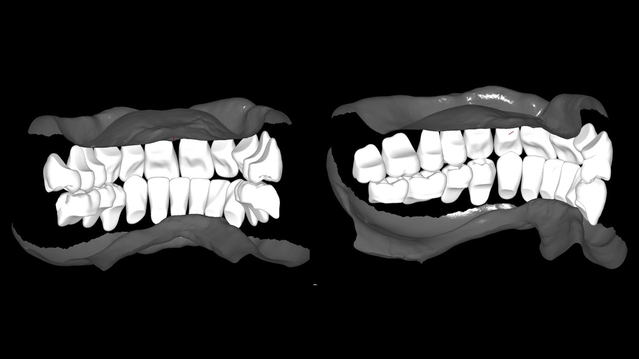 occlusion